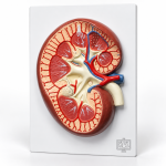 Kidney Stone Model